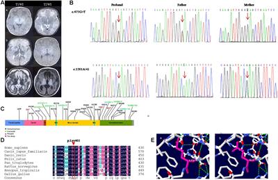 Novel Compound Heterozygous Pathogenic Variants in SUOX Cause Isolated Sulfite Oxidase Deficiency in a Chinese Han Family